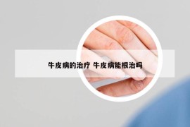 牛皮病的治療 牛皮病能根治嗎