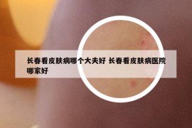 長春看皮膚病哪個(gè)大夫好 長春看皮膚病醫(yī)院哪家好