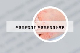 牛皮血癬是什么 牛皮血癬是什么癥狀