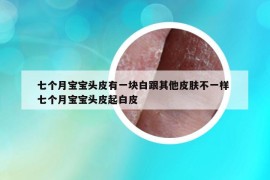 七個(gè)月寶寶頭皮有一塊白跟其他皮膚不一樣 七個(gè)月寶寶頭皮起白皮