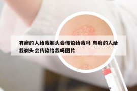 有癬的人給我剃頭會傳染給我嗎 有癬的人給我剃頭會傳染給我嗎圖片