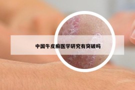 中國牛皮癬醫(yī)學研究有突破嗎