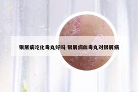 銀屑病吃化毒丸好嗎 銀屑病血毒丸對銀屑病