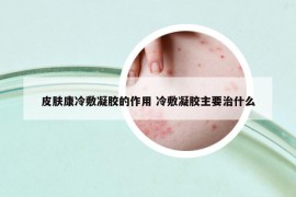 皮膚康冷敷凝膠的作用 冷敷凝膠主要治什么