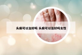 頭癬可以治好嗎 頭癬可以治好嗎女性