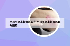 小孩小腿上長癬怎么辦 小孩小腿上長癬怎么辦圖片