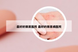 最好的銀屑醫(yī)院 最好的銀屑病醫(yī)院
