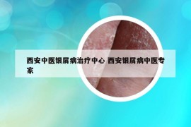 西安中醫(yī)銀屑病治療中心 西安銀屑病中醫(yī)專家