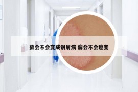 蘚會不會變成銀屑病 癬會不會癌變