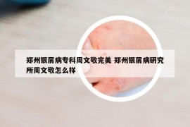 鄭州銀屑病?？浦芪木赐昝?鄭州銀屑病研究所周文敬怎么樣
