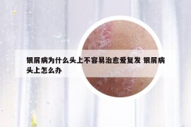 銀屑病為什么頭上不容易治愈愛復發(fā) 銀屑病頭上怎么辦