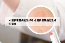 小面積銀屑病能治好嗎 小面積銀屑病能治好嗎女性