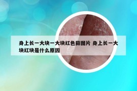 身上長(zhǎng)一大塊一大塊紅色蘚圖片 身上長(zhǎng)一大塊紅塊是什么原因