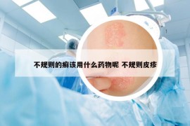 不規(guī)則的癬該用什么藥物呢 不規(guī)則皮疹