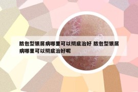 膿包型銀屑病哪里可以徹底治好 膿包型銀屑病哪里可以徹底治好呢