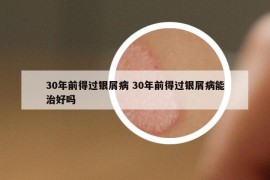 30年前得過(guò)銀屑病 30年前得過(guò)銀屑病能治好嗎