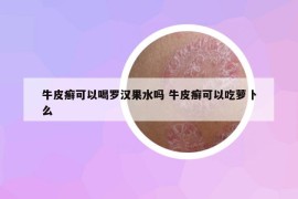 牛皮癬可以喝羅漢果水嗎 牛皮癬可以吃蘿卜么