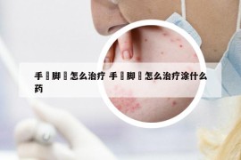 手廯腳廯怎么治療 手廯腳廯怎么治療涂什么藥