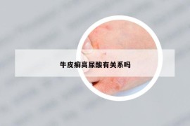 牛皮癬高尿酸有關(guān)系嗎