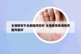 無錫哪家牛皮癬醫(yī)院較好 無錫看銀屑病哪家醫(yī)院最好