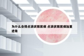 為什么會得點(diǎn)滴狀銀屑病 點(diǎn)滴狀銀屑病加重跡象
