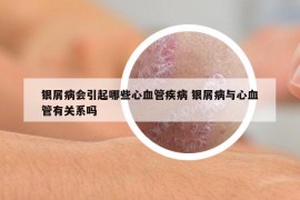 銀屑病會引起哪些心血管疾病 銀屑病與心血管有關(guān)系嗎