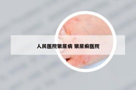人民醫(yī)院銀屑病 銀屑癬醫(yī)院