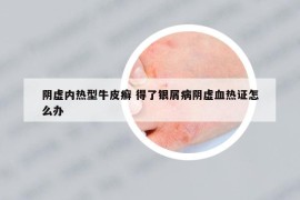陰虛內(nèi)熱型牛皮癬 得了銀屑病陰虛血熱證怎么辦