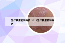 治療銀屑的特效藥 2019治療銀屑的特效藥