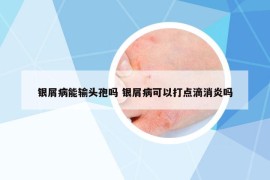 銀屑病能輸頭孢嗎 銀屑病可以打點滴消炎嗎