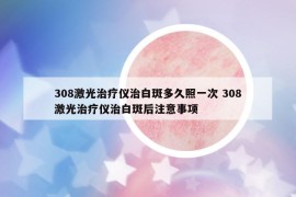 308激光治療儀治白斑多久照一次 308激光治療儀治白斑后注意事項