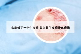 頭皮長了一個牛皮癬 頭上長牛皮癬什么癥狀