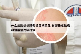 什么皮膚病病理和銀屑病很像 有哪些皮膚病跟銀屑病比較相似