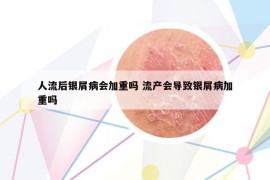 人流后銀屑病會加重嗎 流產(chǎn)會導(dǎo)致銀屑病加重嗎