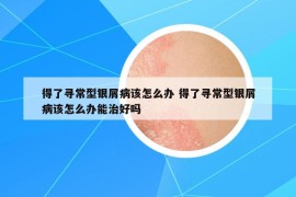 得了尋常型銀屑病該怎么辦 得了尋常型銀屑病該怎么辦能治好嗎