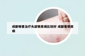成都哪里治療頭部銀屑病比較好 成都看銀屑病