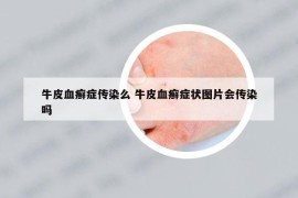牛皮血癬癥傳染么 牛皮血癬癥狀圖片會傳染嗎