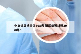 全身銀屑病能做308嗎 銀屑病可以照308嗎?
