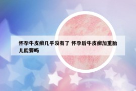 懷孕牛皮癬幾乎沒有了 懷孕后牛皮癬加重胎兒能要嗎
