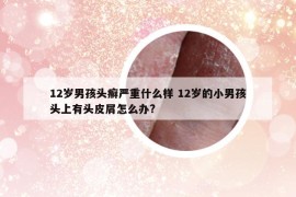 12歲男孩頭癬嚴重什么樣 12歲的小男孩頭上有頭皮屑怎么辦?