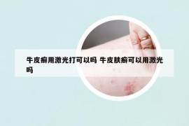 牛皮癬用激光打可以嗎 牛皮膚癬可以用激光嗎