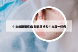 牛皮癬副銀屑病 副銀屑病和牛皮屑一樣嗎