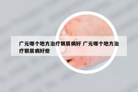 廣元哪個地方治療銀屑病好 廣元哪個地方治療銀屑病好些
