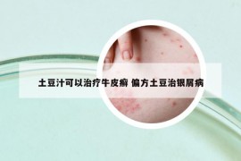 土豆汁可以治療牛皮癬 偏方土豆治銀屑病