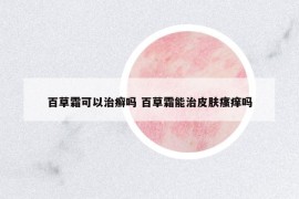 百草霜可以治癬嗎 百草霜能治皮膚瘙癢嗎