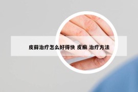 皮蘚治療怎么好得快 皮癬 治療方法