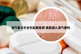 濕氣重會(huì)不會(huì)引起銀屑病 銀屑病人濕氣重嗎