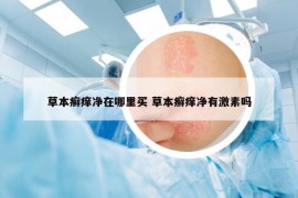 草本癬癢凈在哪里買 草本癬癢凈有激素嗎