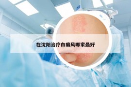 在沈陽治療白癜風哪家最好