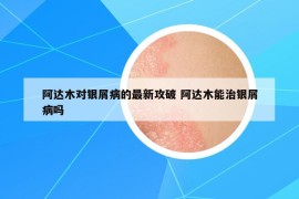 阿達(dá)木對銀屑病的最新攻破 阿達(dá)木能治銀屑病嗎